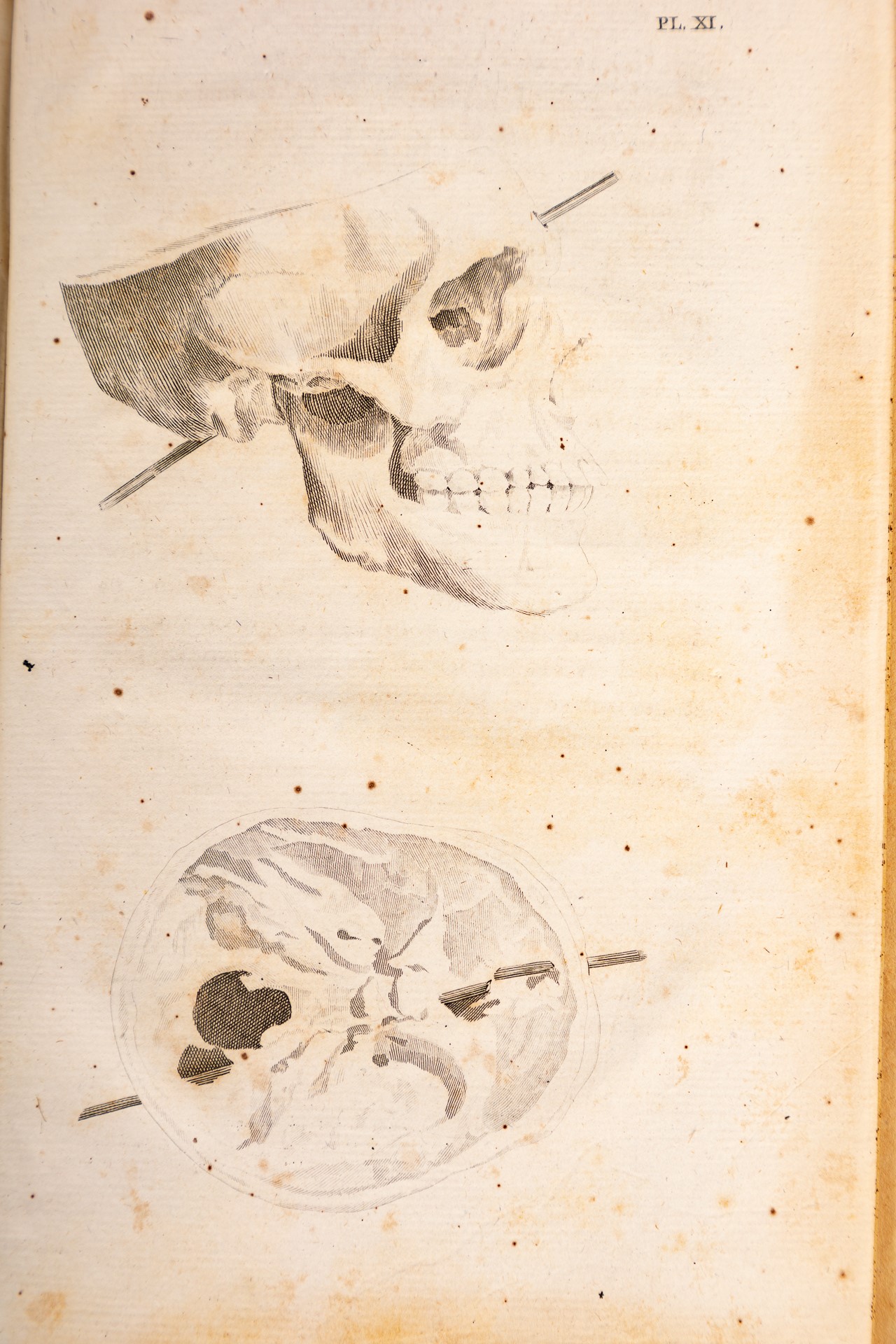 Mémoires de chirurgie militaire, et campagnes